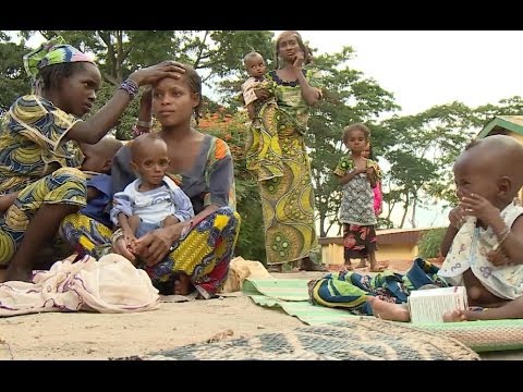 الكاميرون: أطفال يعانون من سوء التغذية 