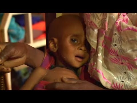 Cameroon:  Malnourished Children