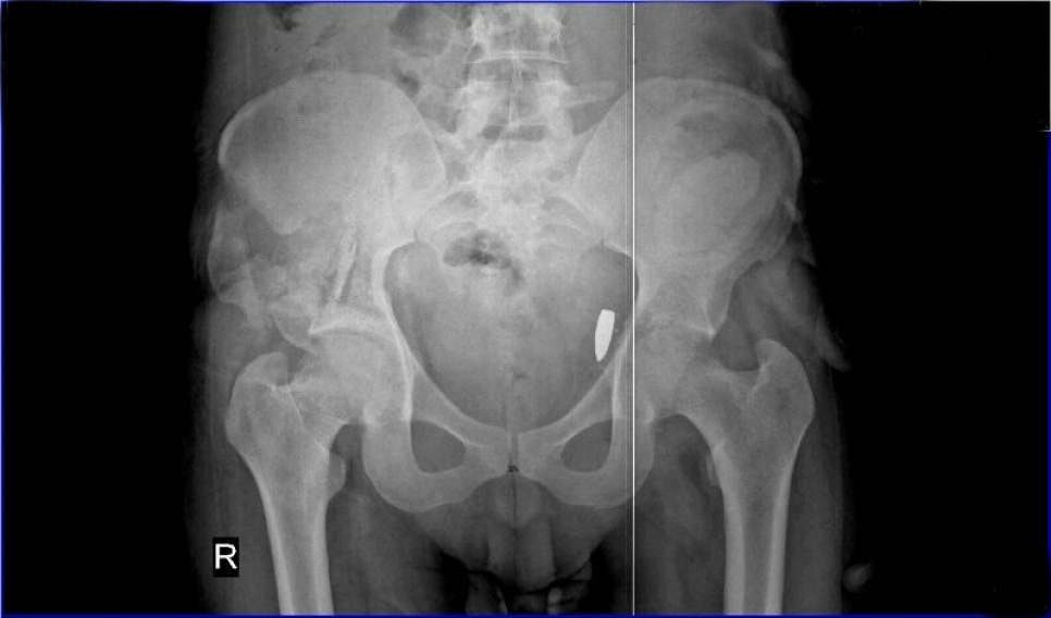 "The doctor came and showed me the bullets they took out. He showed me four bullets. One is still inside my body." An X-ray taken in Turkey shows the location of the fifth bullet.