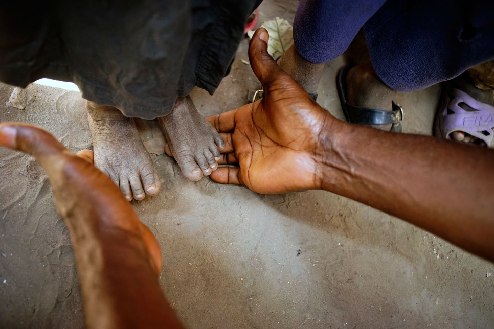 A nutrition expert checks a young refugee's feet for signs of malnutrition at the Gbadakila site in DRC's Equateur Province.
