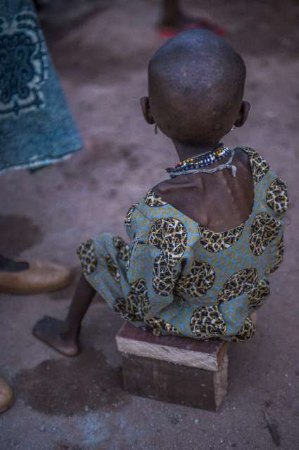طفل يعاني من سوء التغذية الحاد، تظهر عظامه ناتئة تحت الجلد، يجلس على بديل لكرسي في مركز التغذية في باتوري.