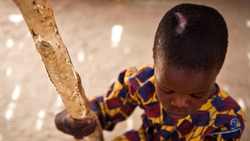 The crescent-shaped scar on Ibrahim’s head is a visible reminder of his ordeal.