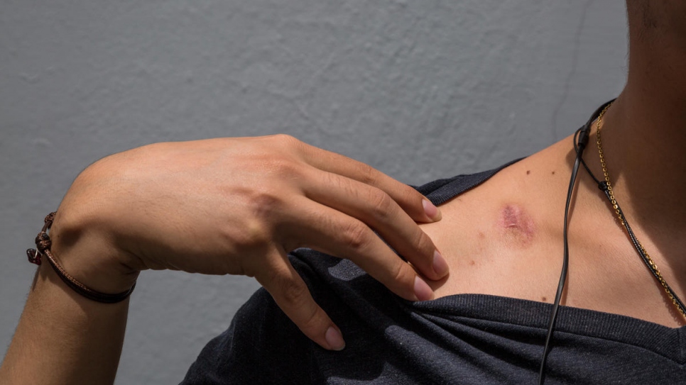 Lobo,* étudiant en médecine de 21 ans, montre les cicatrices des violences qu'il a endurées durant les troubles au Nicaragua. 