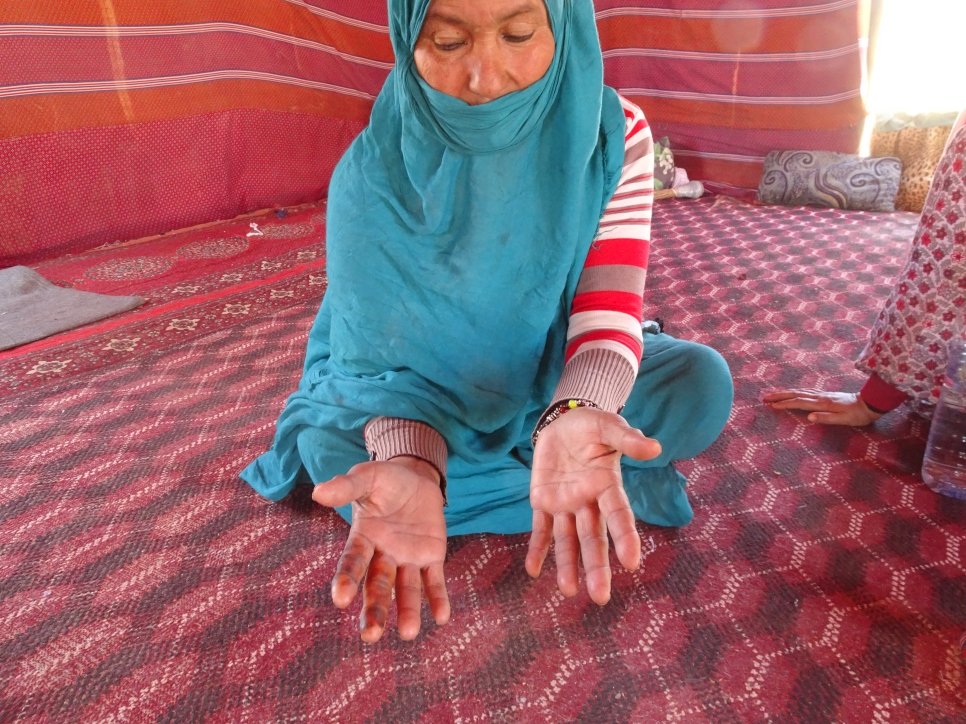 مباركة تظهر لنا يديها وكيف يبدو على أصابعها التورم من الخياطة خلال ترميم خيمتها.