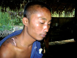 An escaped convict porter shows scars from carrying heavy loads of military supplies in Karen State. Courtesy of Free Burma Rangers