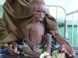 A malnourished child from southern Somalia sits in Banadir hospital in Mogadishu.